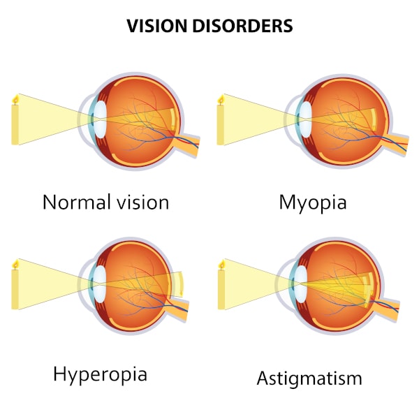 Schéma des principaux troubles de la vision